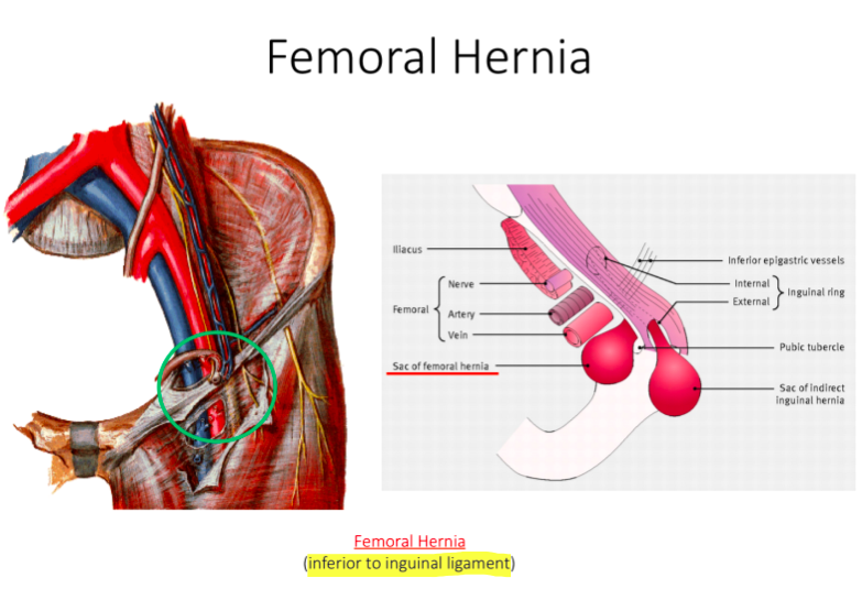 Femoral Hernia treatment in Nashik