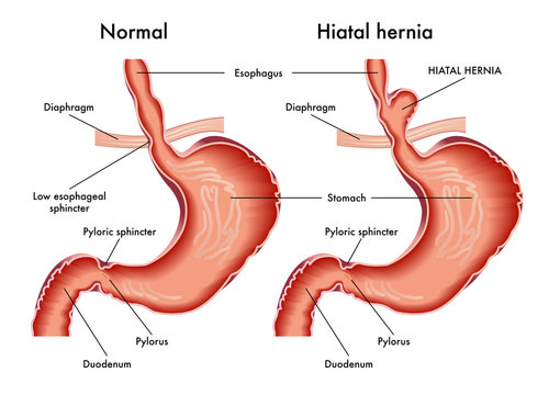 Hiatal Hernia Treatment in Nashik