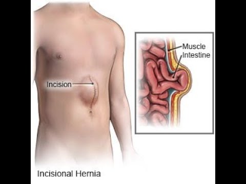 Incisional Hernia Treatment in Nashik