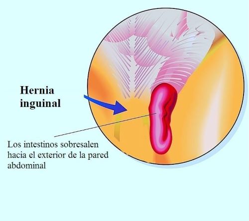 Inguinal Hernia treatment in Nashik