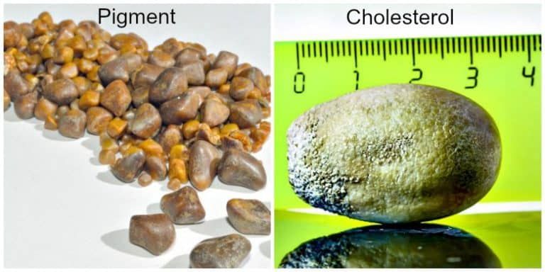 Gallstones treatment in Nashik