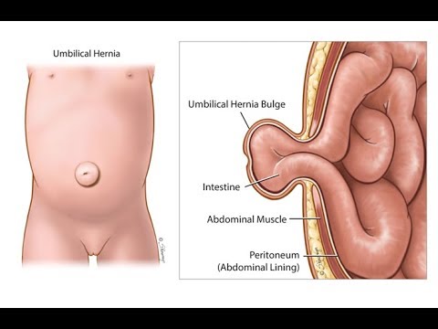 Umbilical Hernia Treatment in Nashik