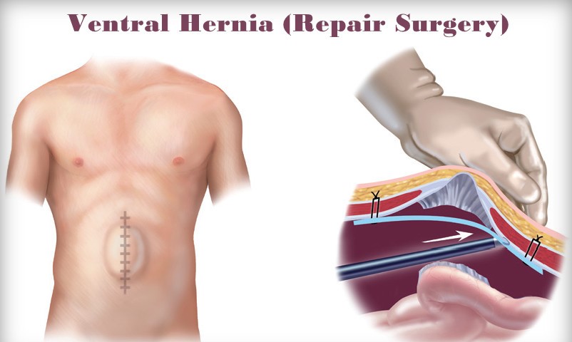 Ventral Hernia Treatment in Nashik